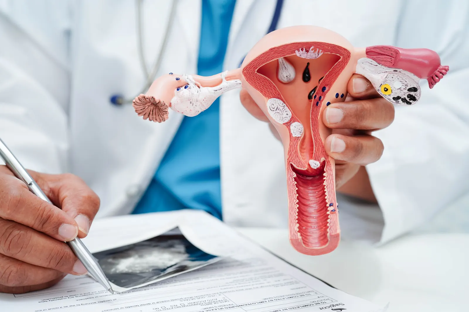 Doctor holding an anatomical model of the uterus